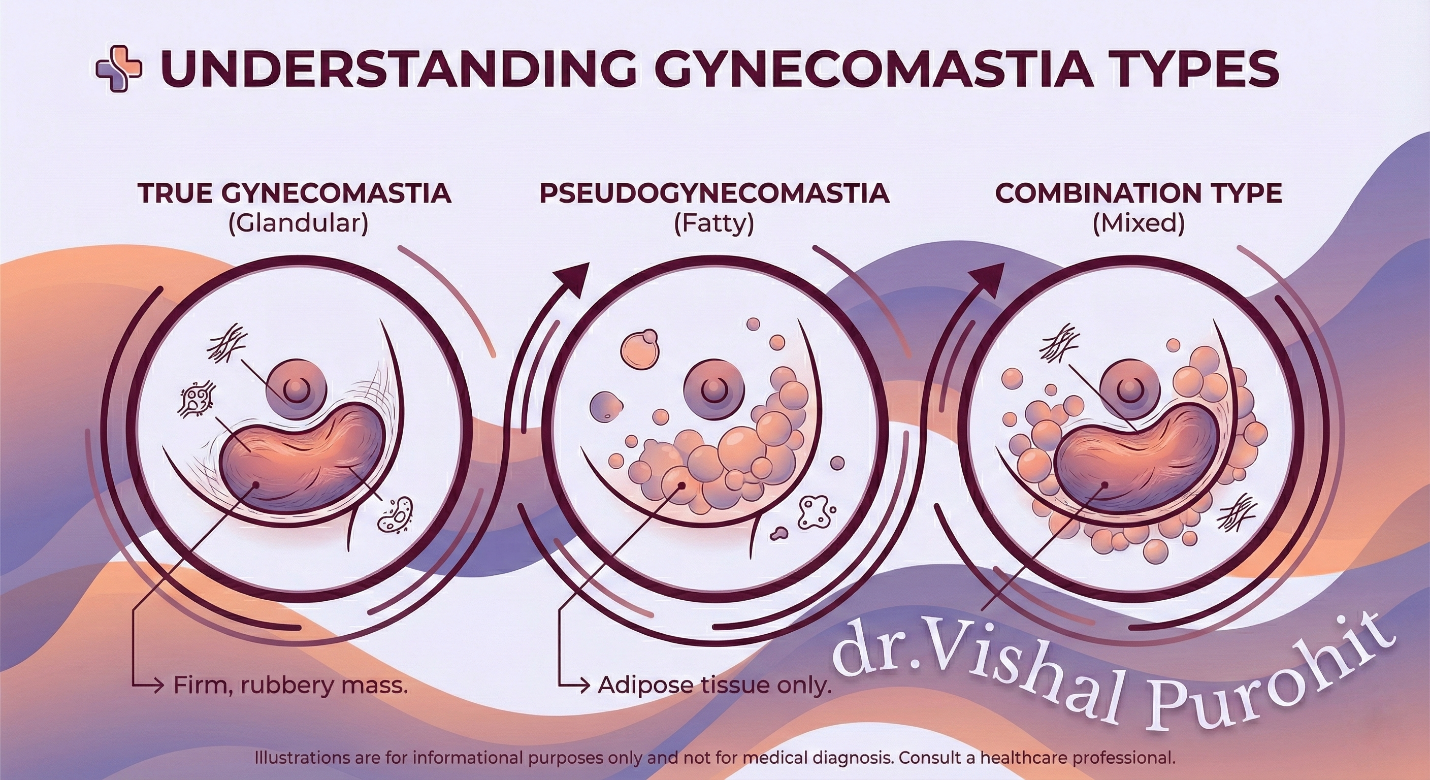 Infographic titled 'UNDERSTANDING GYNECOMASTIA TYPES' by dr.Vishal Purohit, illustrating three types: True Gynecomastia (Glandular) with a firm, rubbery mass; Pseudogynecomastia (Fatty) with adipose tissue only; and Combination Type (Mixed) which is the most frequent form.