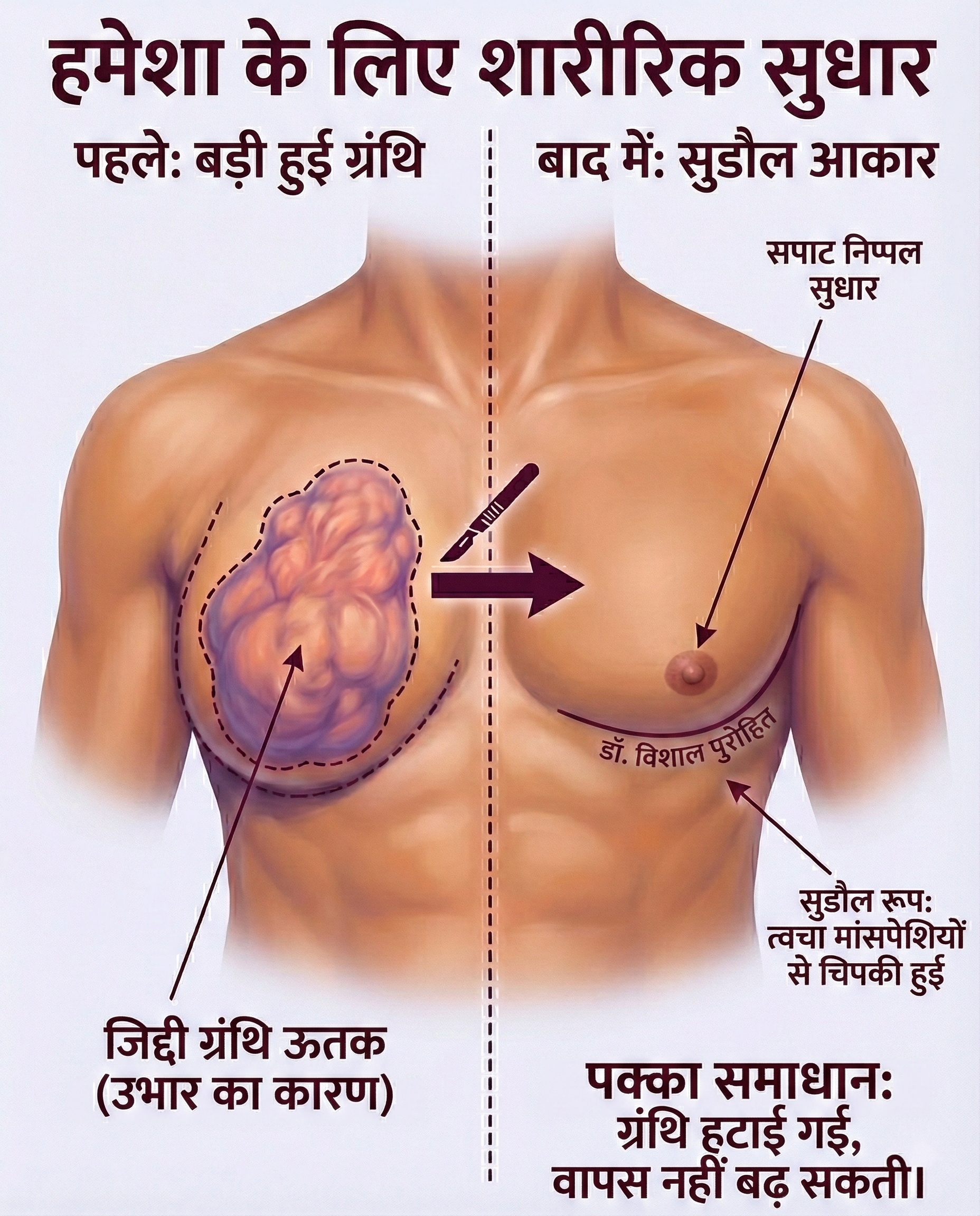 Before and after illustration of severe gynecomastia gland excision for sculpted chest contour.