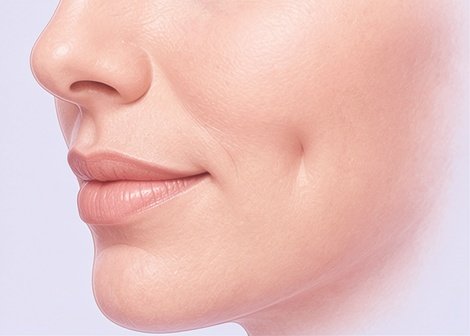 Natural lip augmentation and facial contouring result by Dr. Vishal Purohit in Jaipur
